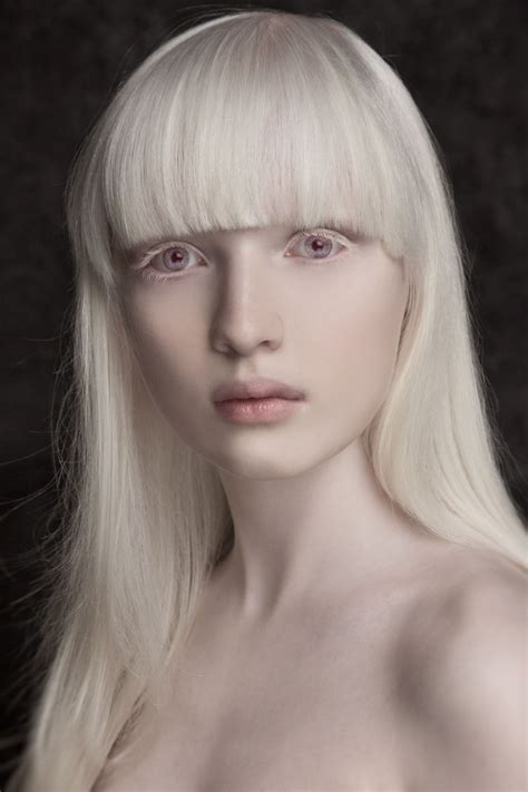 3 Highly sensitive skin to sunlight 2. . Albino porn pics
